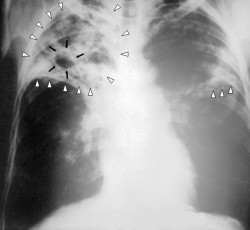 Туберкулёз лёгких